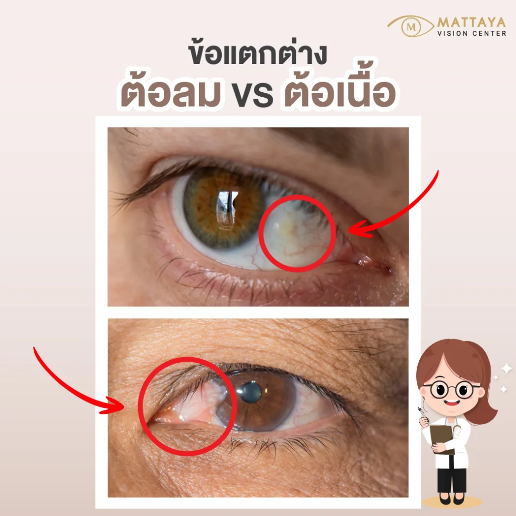 ความแตกต่างระหว่าง "ต้อลม" และ "ต้อเนื้อ"