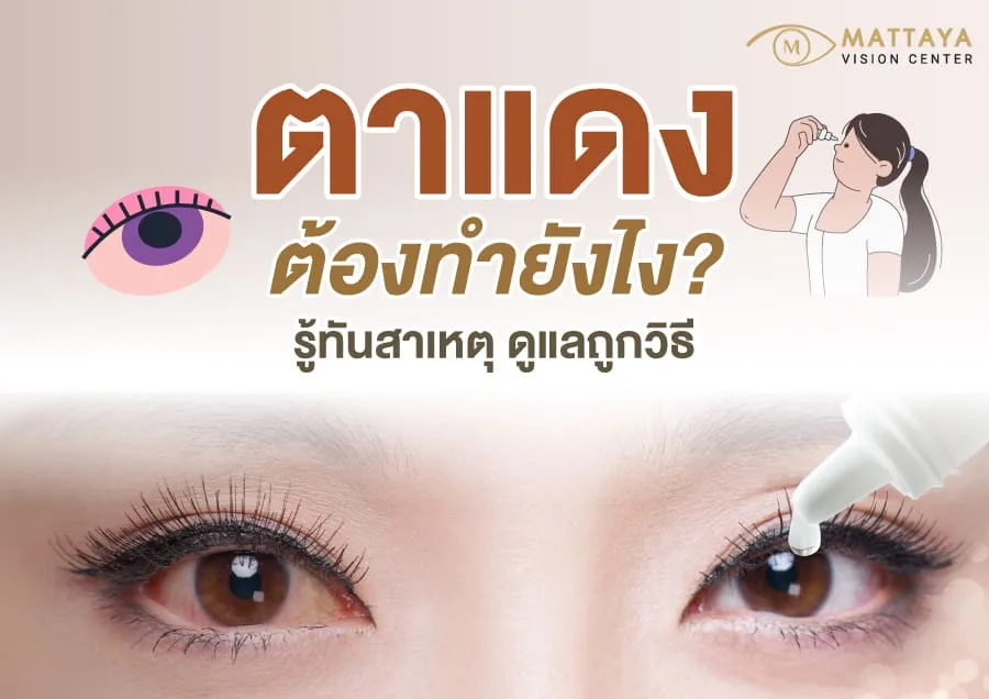 ตาแดงต้องทำยังไง? วิธีดูแลและรักษาอย่างถูกต้อง