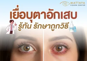 เยื่อบุตาอักเสบ สาเหตุ อาการ วิธีรักษา และป้องกัน ฉบับเข้าใจง่ายจากใจจักษุแพทย์